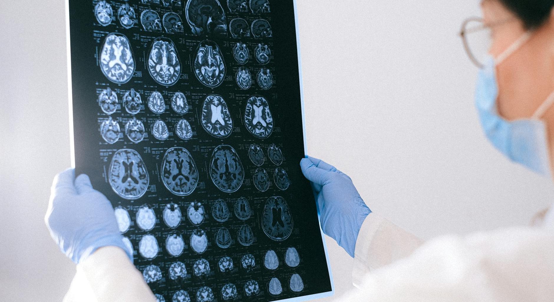 a doctor holding an mri result of the brain